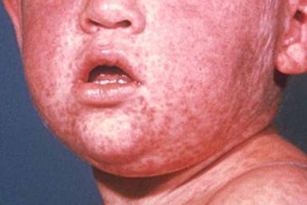 mumps rash